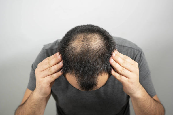 Alopecia(Hair Loss) treatment with Homeopathy - YourMedkart - YourMedKart